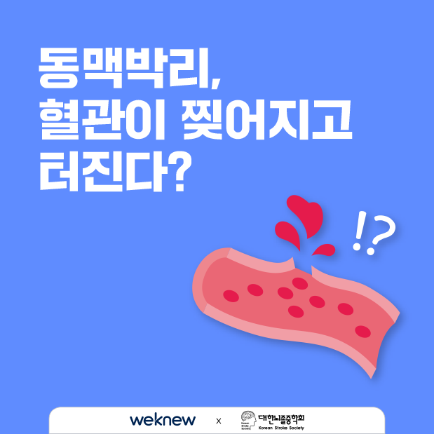 눈에도 뇌졸중이 온다 